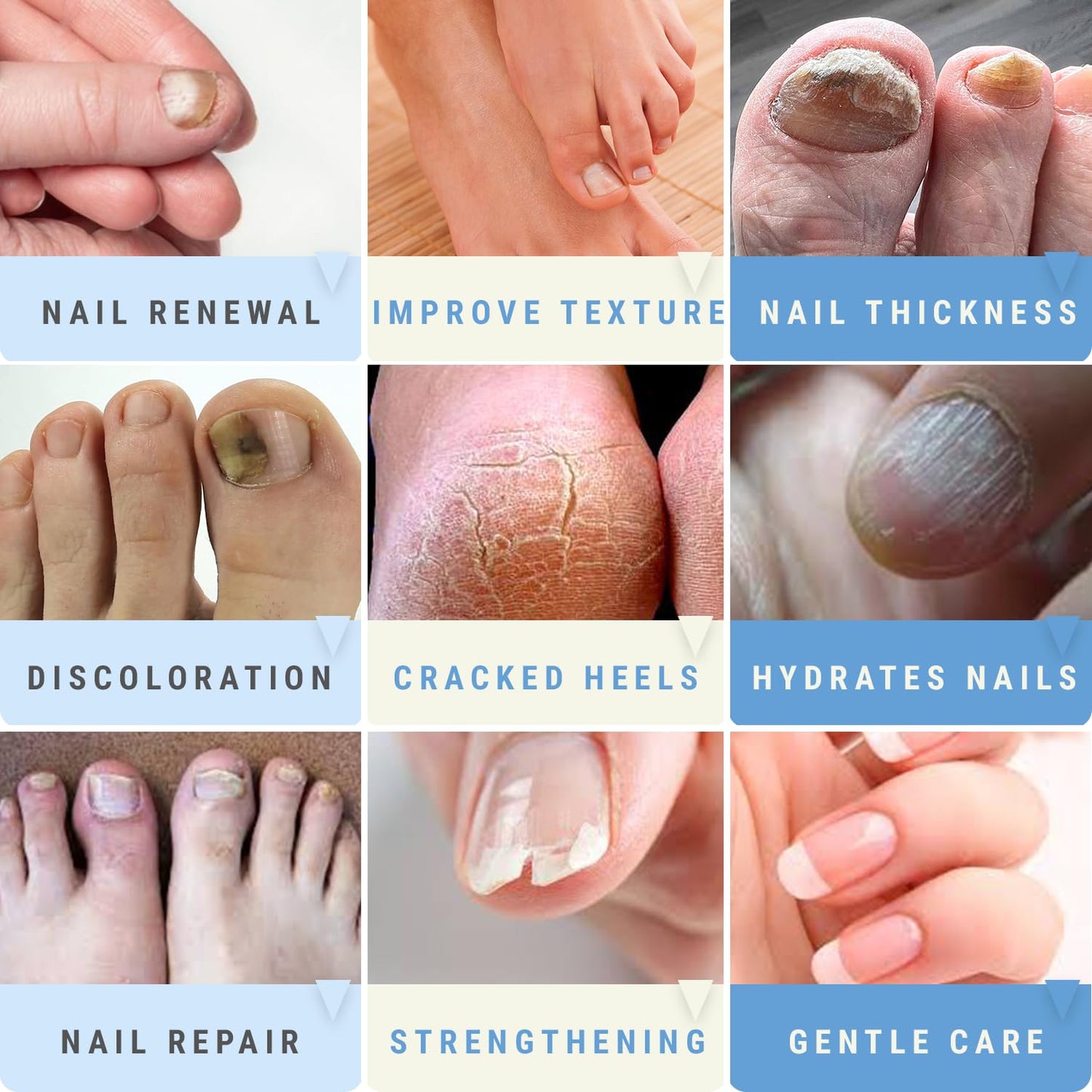 Urea 50% Nail Gel - Softens Cracked Heel Calluses & Thick Toenails