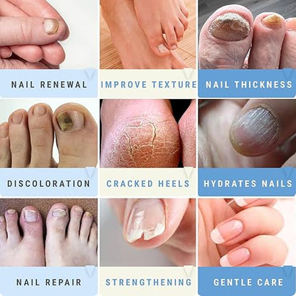 Urea Nail Gel Combo Pack